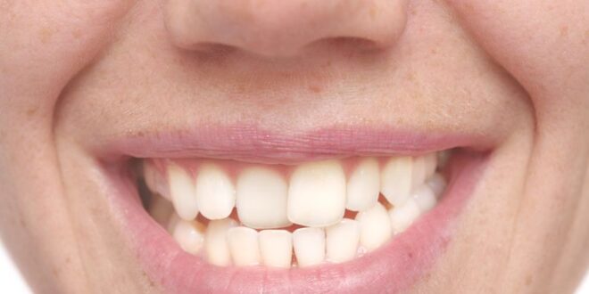 Apa Penyebab Gigi Bengkok, Bagaimana Cara Memperbaikinya?